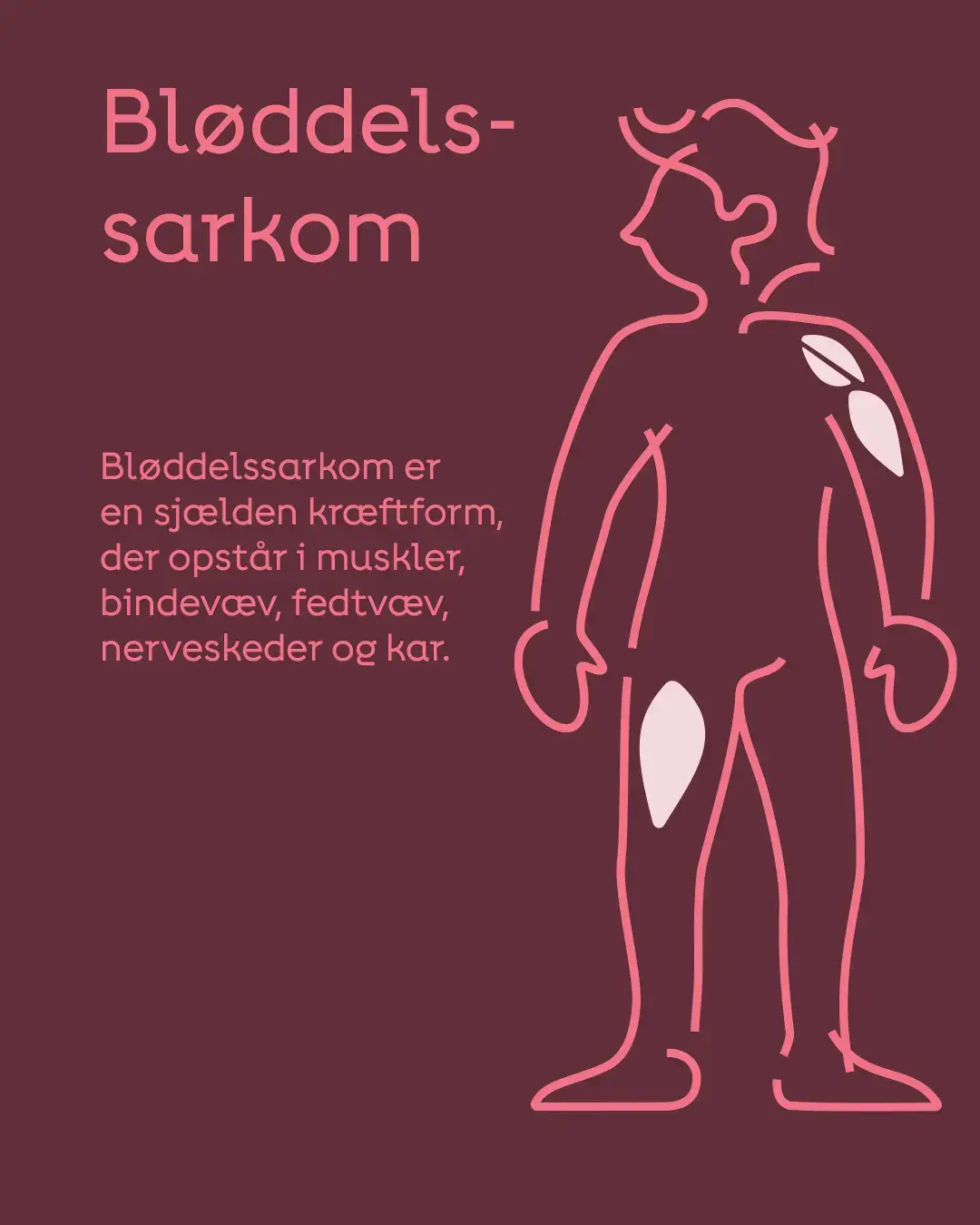 bløddelssarkom – pindemand 23feb26